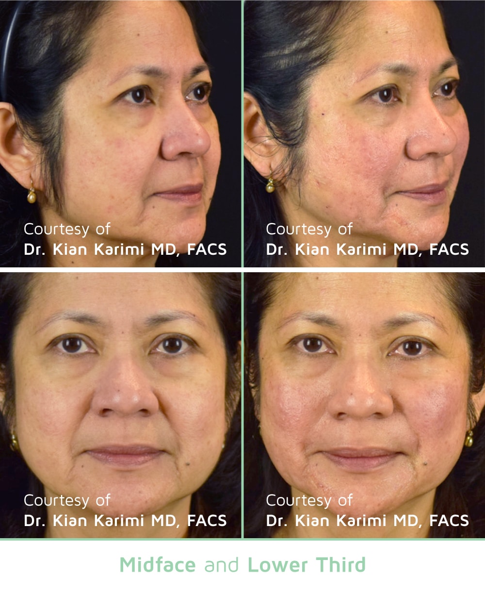 Woman's before and after results from PDO Thread Lift treatment.