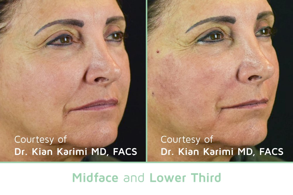 Woman's before and after results from PDO Thread Lift treatment.