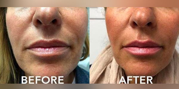 Woman's before and after results from dermal fillers by Dr. Anita of PHI Aesthetics.