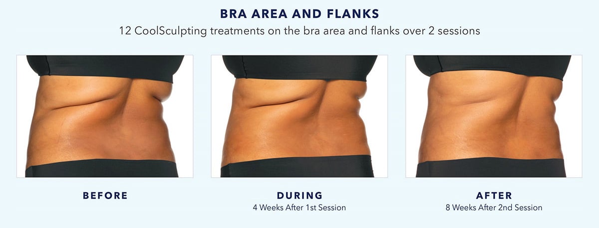 https://dranita.com/wp-content/uploads/2021/11/Coolsculpting-before-and-after-bra-area-and-flanks.jpg